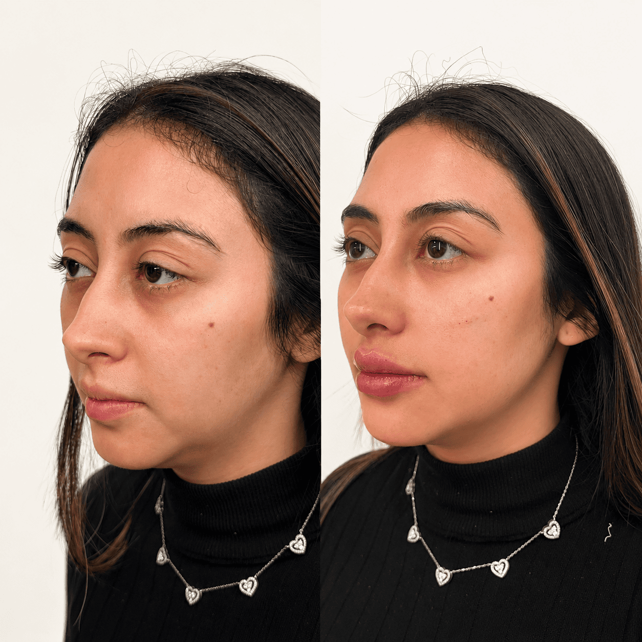 Antes e depois 10